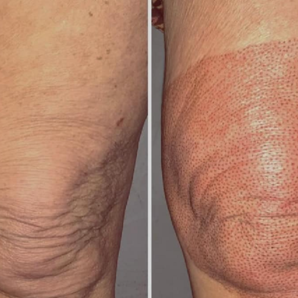 Fibroblast Flacidez Rodillas