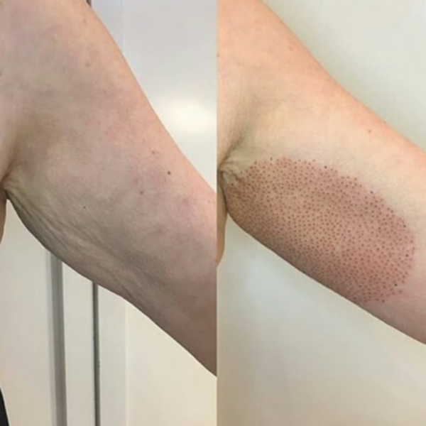 Fibroblast Flacidez en Brazos