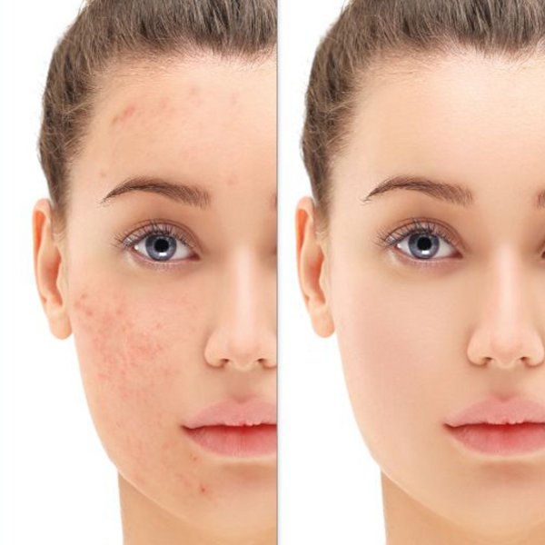 Peeling Tratamiento Acné