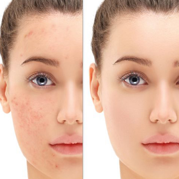 Peeling Quimico Tratamiento Acné 4 Sesiones