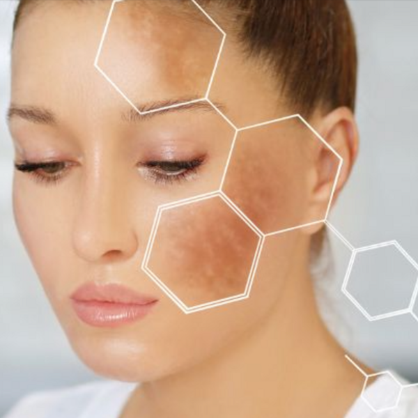 Peeling Tratamiento Manchas