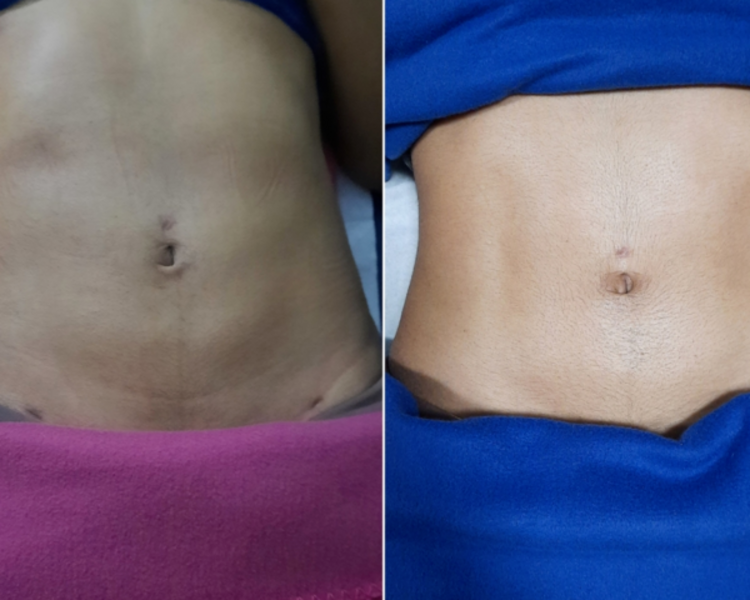 Tratamiento Post Operatorio