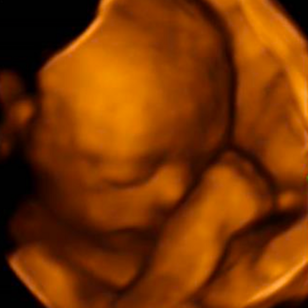 Ultrasonido estructural