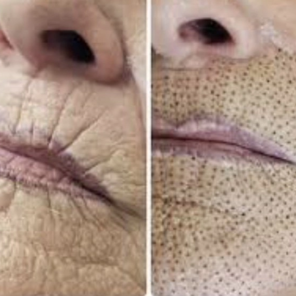 Fibroblast Código de Barras Zona Peribucal Superior e Inferior