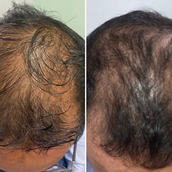 AGF Regeneración Folículo Capilar