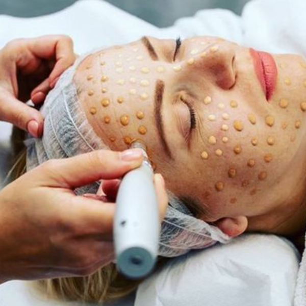 Eliminación de Verrugas