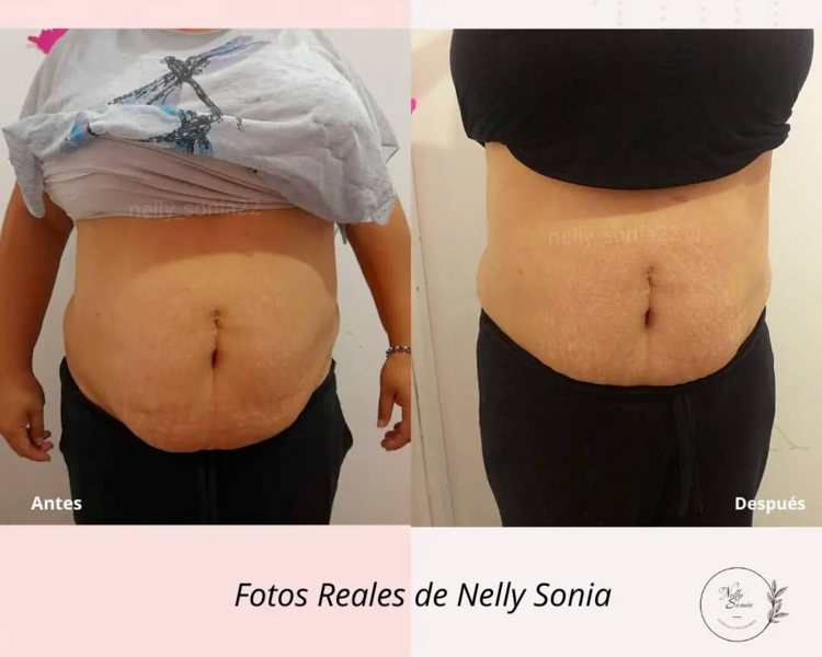 LIPOLASER CON MADEROTERAPIA