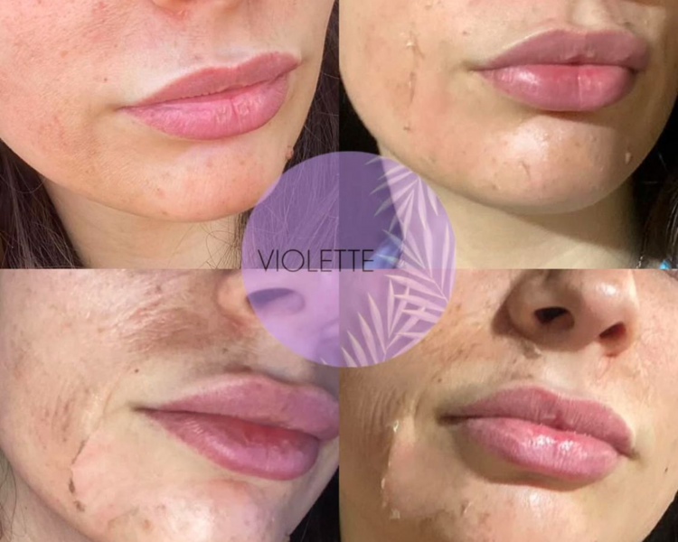 Peeling descamante (colocación de ácido) 