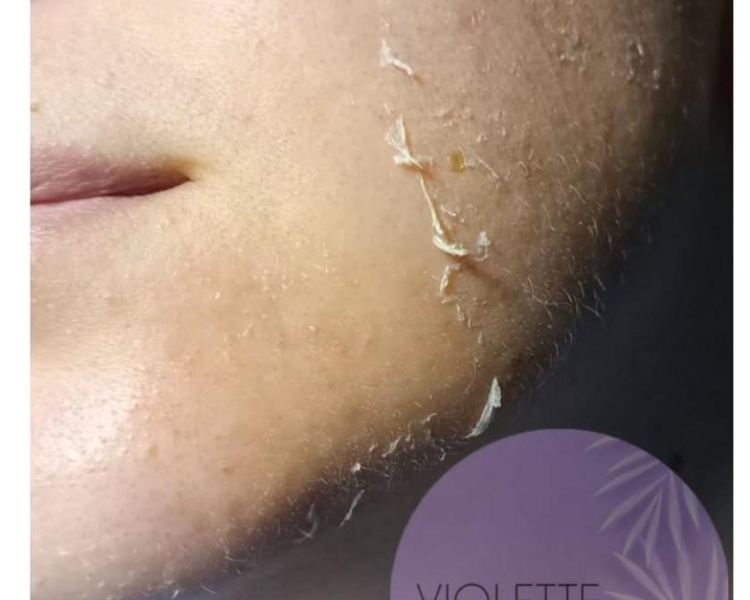 Peeling descamante (colocación de ácido) 