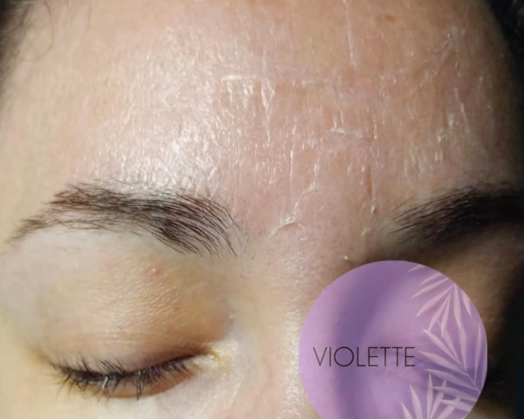 Peeling descamante (colocación de ácido) 