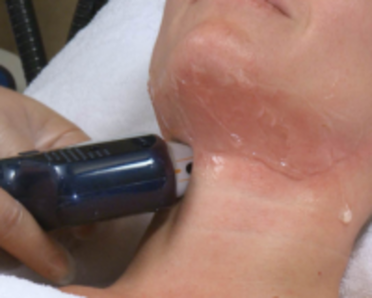 HIFU 10D Cuello