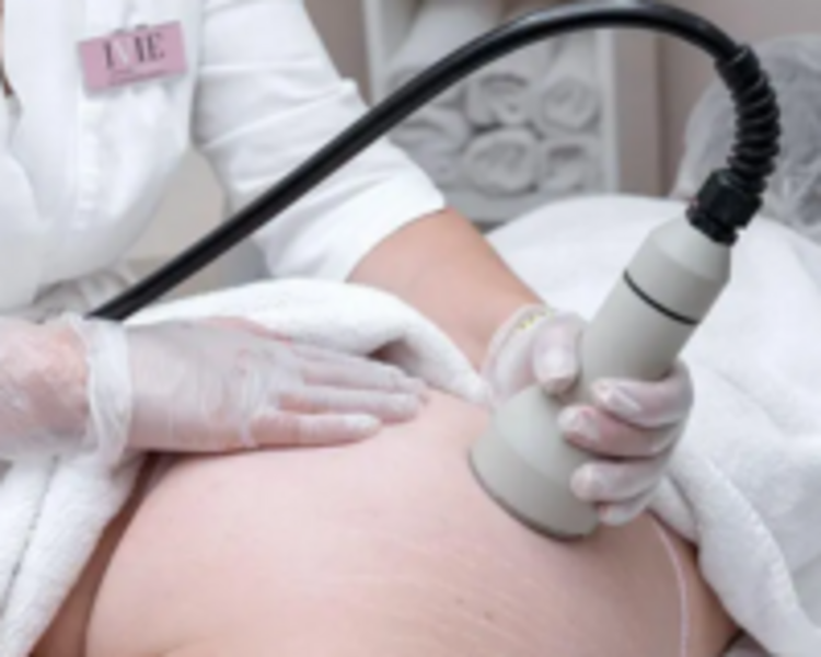 HIFU 10D POR CADA ZONA GRANDE: Abdomen, Glúteos, Muslos por delante, Muslos por detrás.  