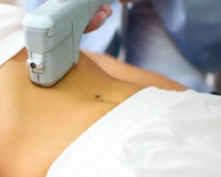 HIFU CORPORAL ABDOMEN