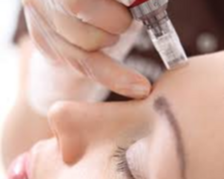 Microneeding Plus (Con extracción de puntos negros)