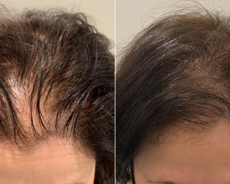 Micropigmentacion capilar 