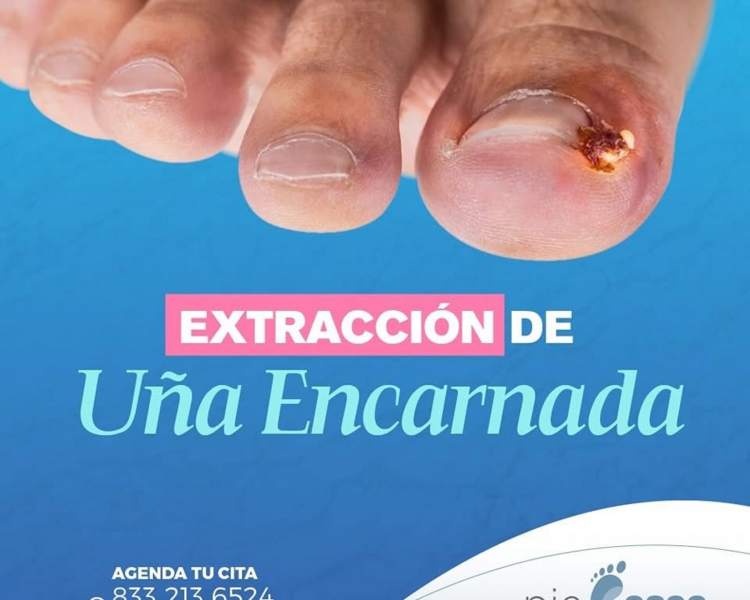 Extracción Uña Encarnada