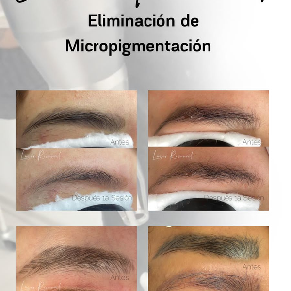 Remoción de Tatuajes (4 sesiones)