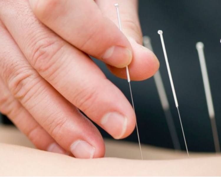 Acupuntura