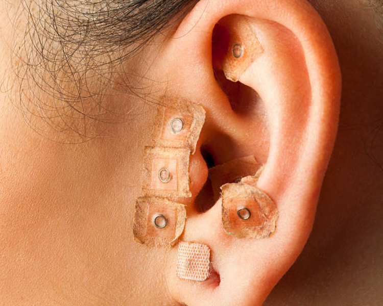 Auriculoterapia