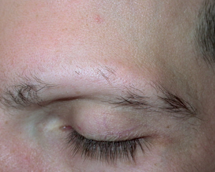 Reconstrucción de cejas para personas con Alopecia