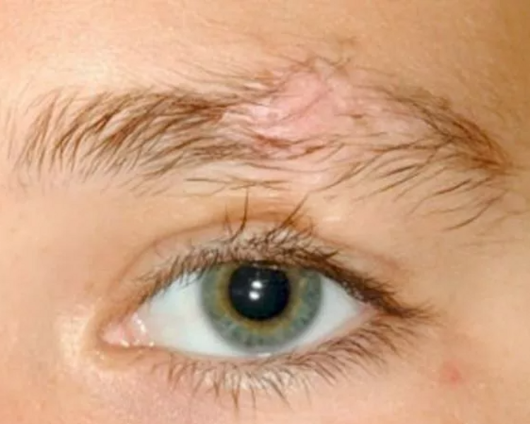 Reconstrucción de cejas para personas con Alopecia