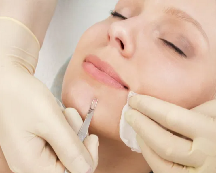 Facial + Extracciones