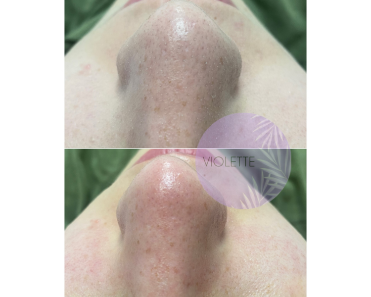 Higiene facial profunda