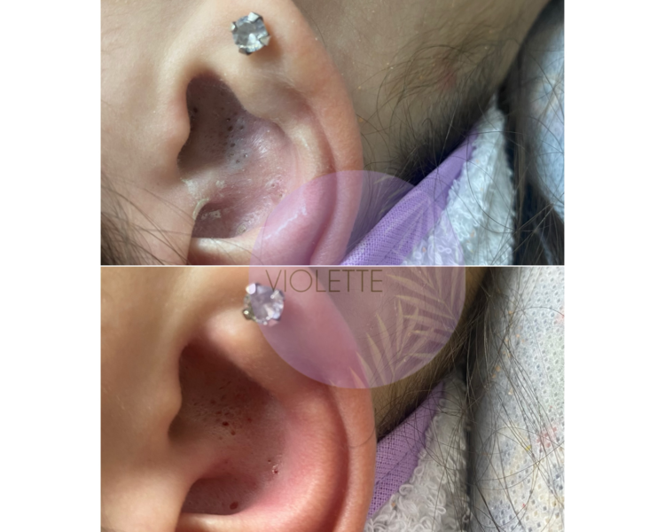 TRATAMIENTO SOBRE PIELES ACNEICAS- DERMATOCOSMIATRIA