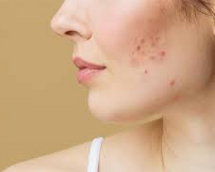 LIMPIEZA FACIAL ACNÉ