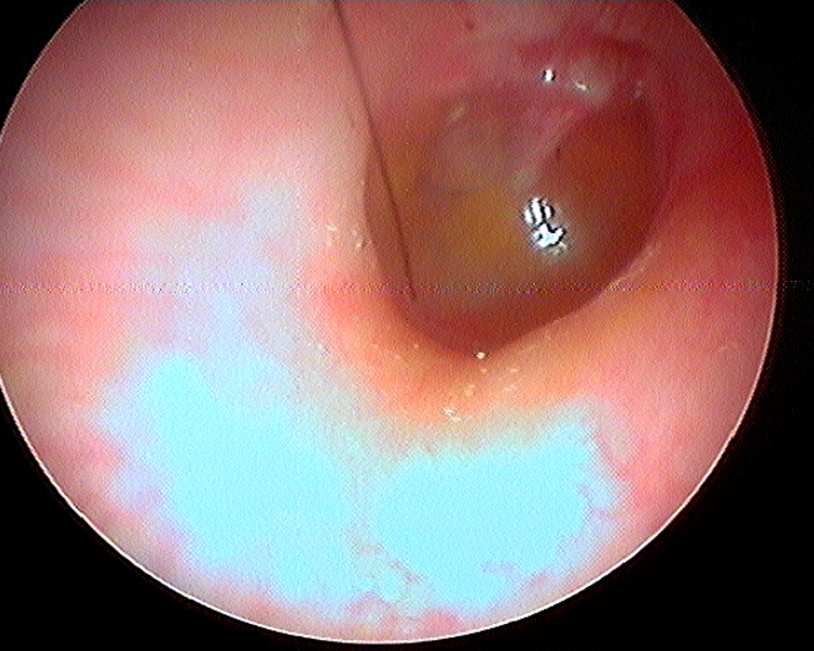 Consulta (de PRIMERA VEZ) Otorrinolaringología