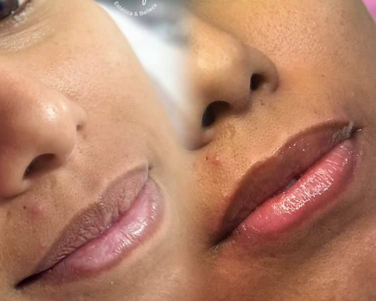 Hidratacion De Labios (4 Sesiones) 