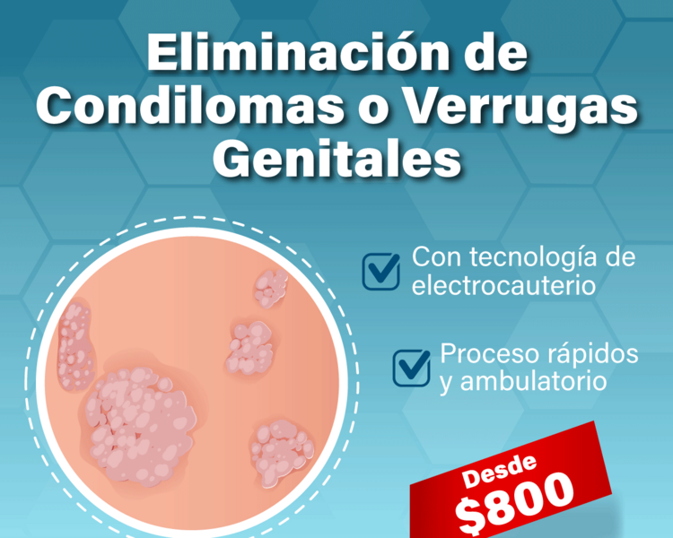 Cauterización/Eliminación de Condilomas o Verrugas genitales