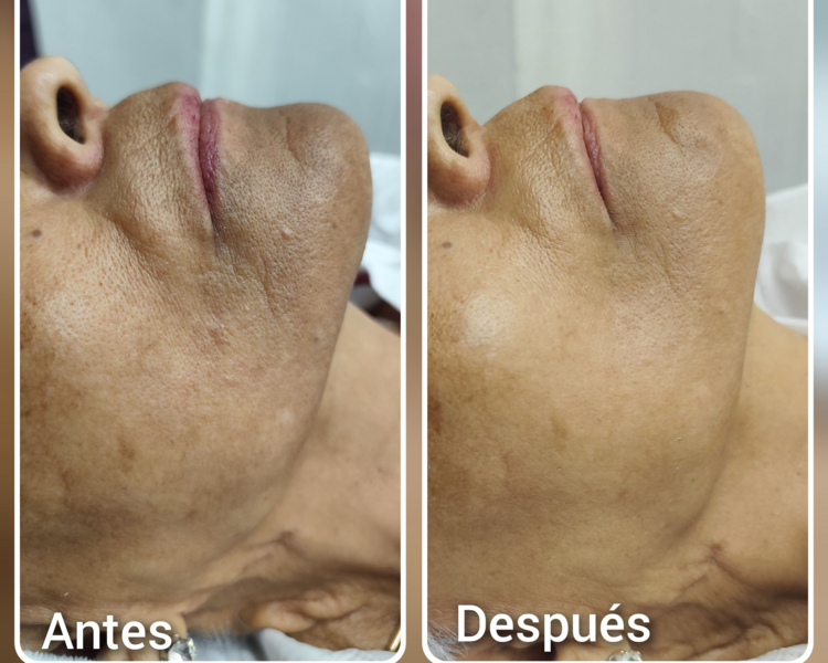 Peeling Enzimático 