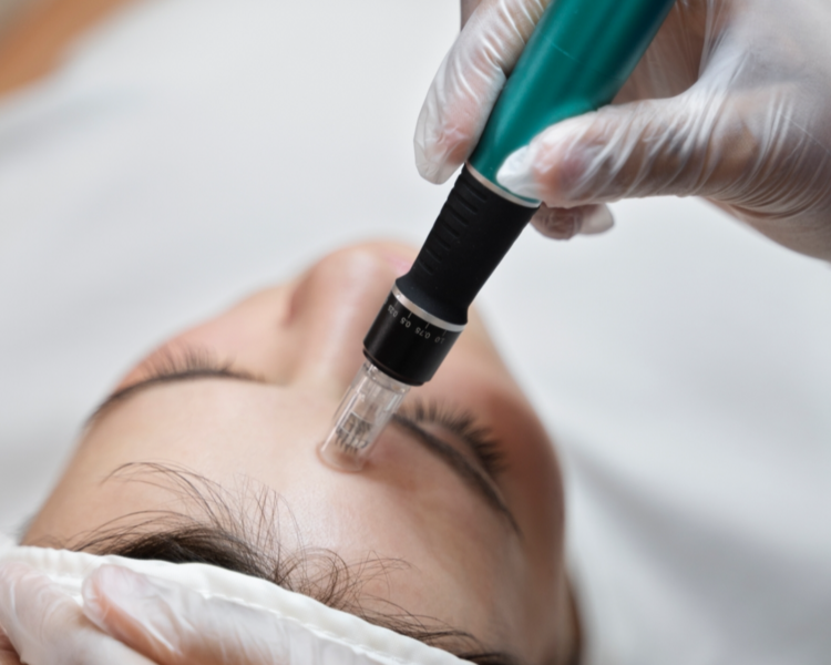 Rejuvenecimiento Facial con Microneedling 
