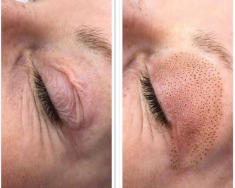 Promocion Plasma Fibroblast Para Ojos