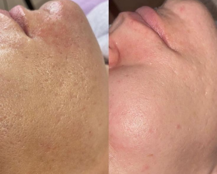 Limpieza profunda con dermaplaning + mascarilla