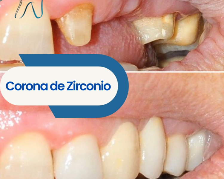Re-cementación de corona 