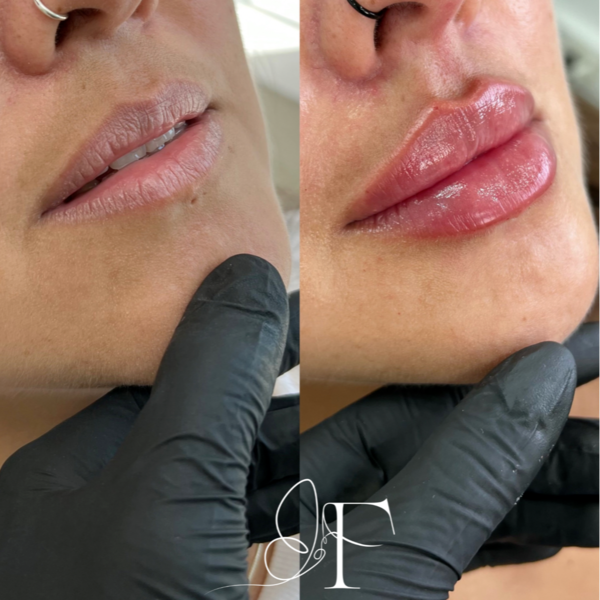 Aumento de labios con ácido hialurónico