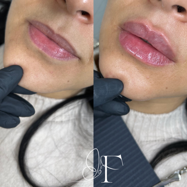 Aumento de labios con ácido hialurónico
