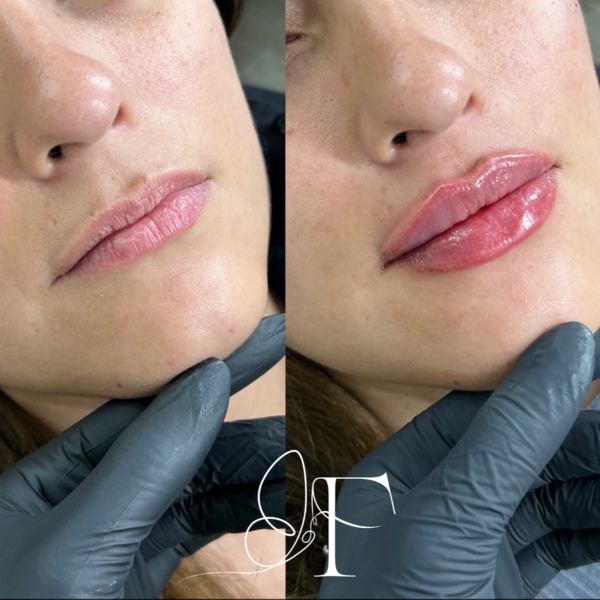 Aumento de labios con ácido hialurónico