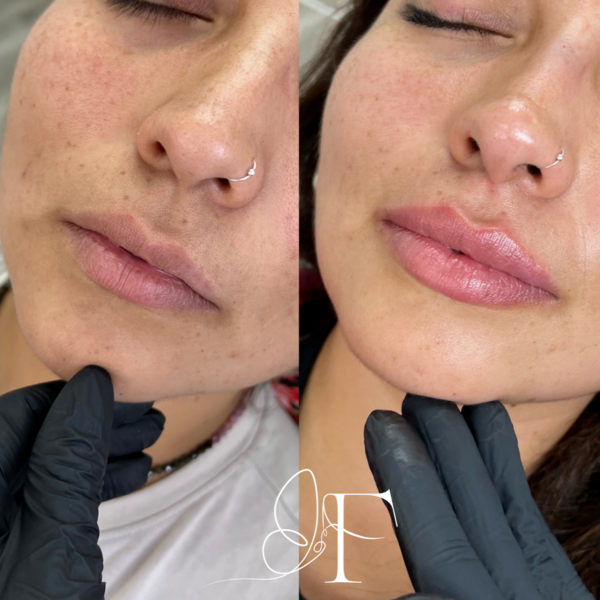 Rinolips - rinomodelación + aumento de labios 
