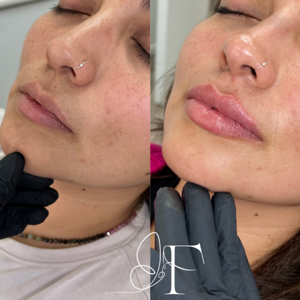 Rinolips - rinomodelación + aumento de labios 