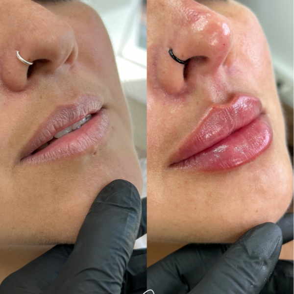 Rinolips - rinomodelación + aumento de labios 