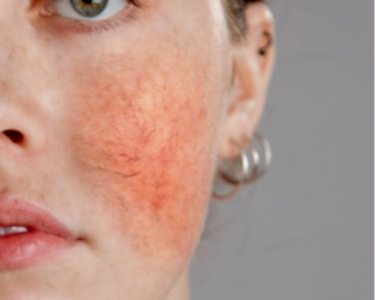 Pieles Sensibles ó con Rosácea. 