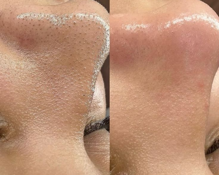 Limpieza facial profunda