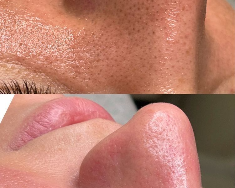 Limpieza facial profunda