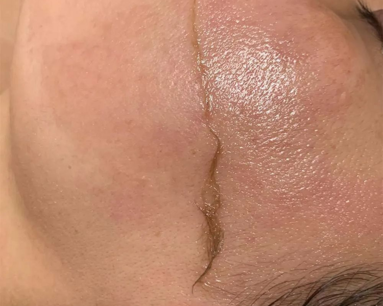 Sesion de dermaplaning