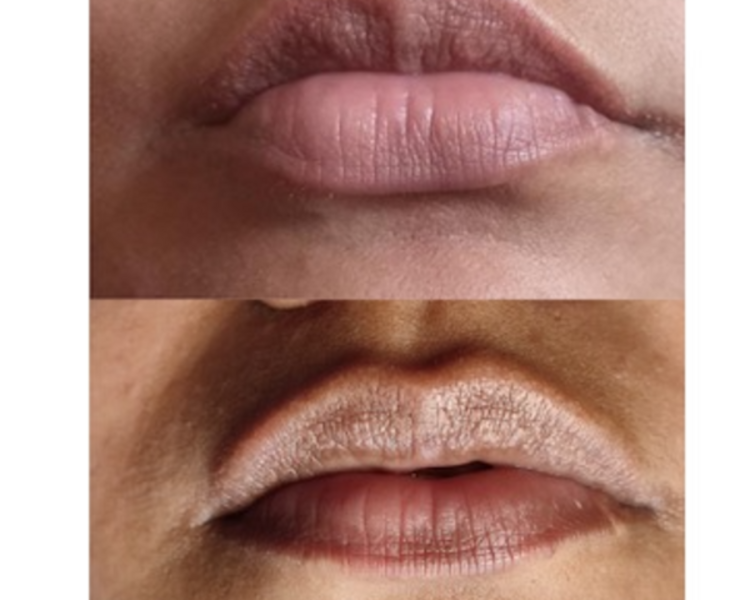 LABIOS NEUTRALIZACION