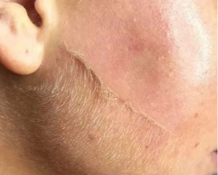 CONTOL ACNE II