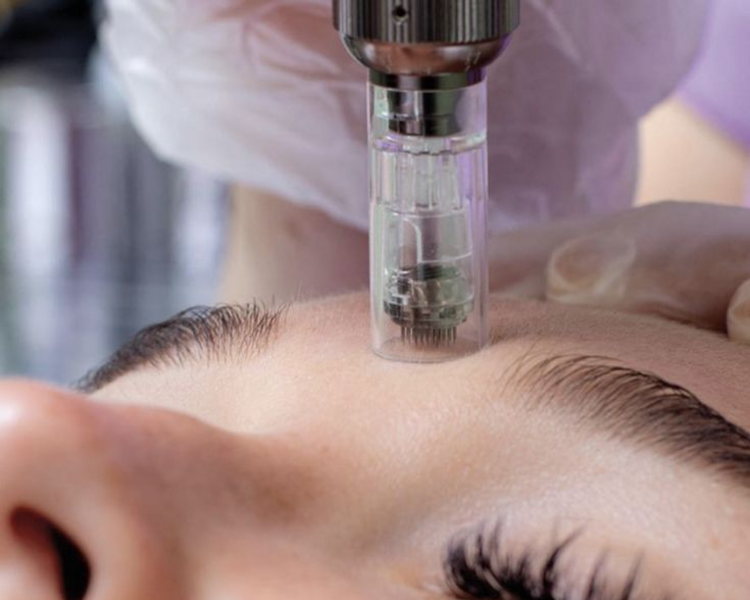 MICRONEEDLING